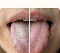 Dry tongue versus a hydrated tongue