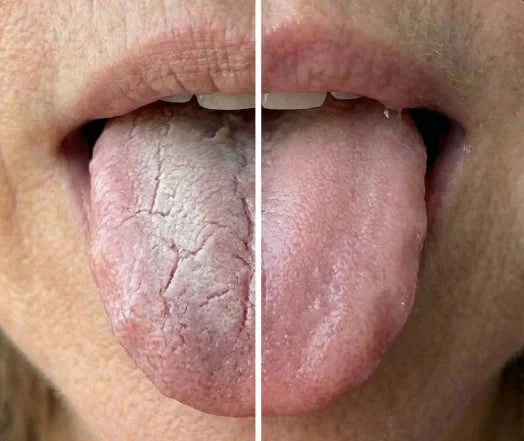 It Stops Dry Mouth